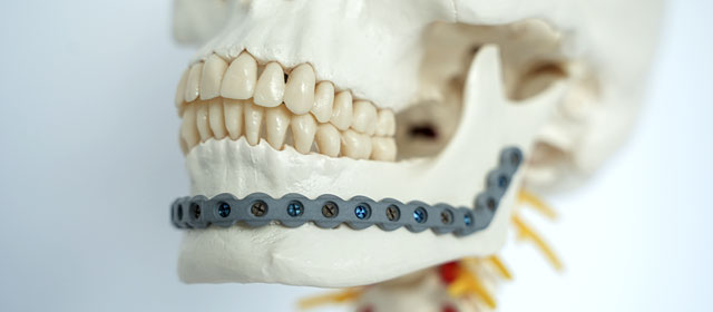 Unterkieferimplantat mit entzündungshemmender Beschichtung